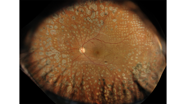 GAIA diabetic retinopathy