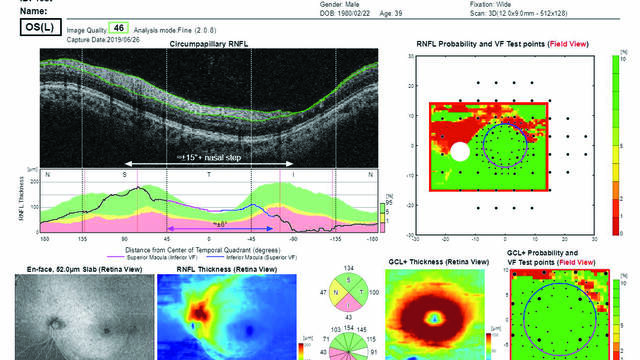 3D OCT Maestro 2, Hood Report con módulo para evaluación del defecto neuronal y el área del campo visual afectado