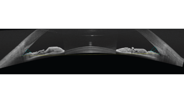 OCT Image B-scan Length (16mm)