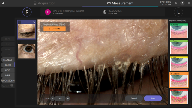 blepharitis assessment