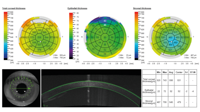 corneal thickness maps