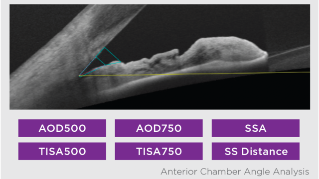 Anterior Chamber Angle Analysis