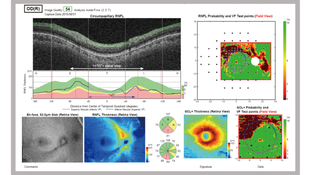 The Hood Report for Glaucoma
