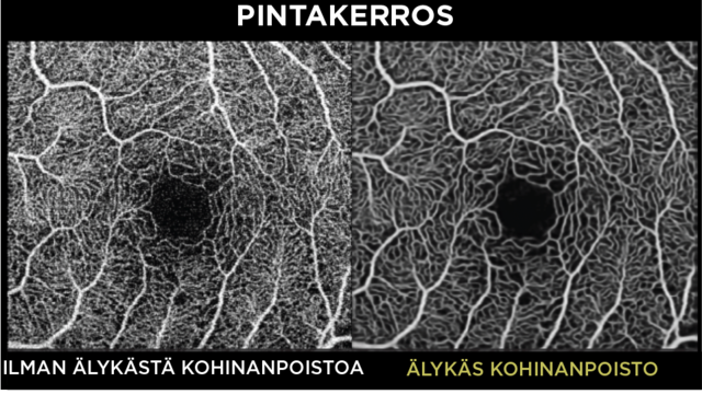 älykäskohinanpoisto