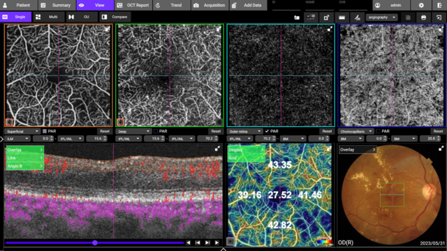SS OCT Angiography