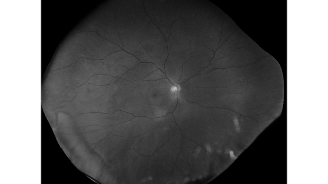 GAIA red-free image