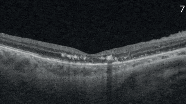 Syphilis oculaire